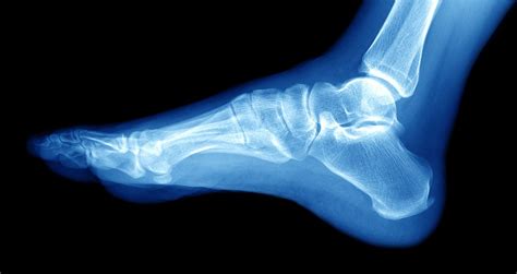 Lateral Malleolus Fracture Symptoms and Treatment