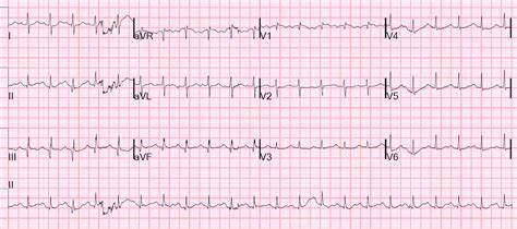 Dr. Smith's ECG Blog: Why did this patient have ventricular fibrillation?