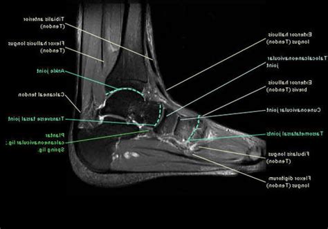 Foot Muscle Anatomy Mri