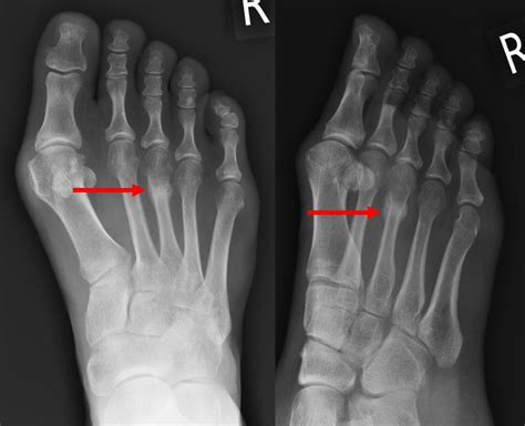 Stress fracture of Metatarsal - OC Foot and Ankle Clinic