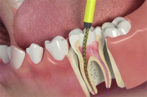 Tooth Abscess: Treatment, Symptoms, & Causes | Monroe Family Dentist