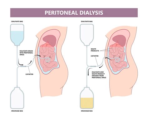 What Is Peritoneal Dialysis? National Kidney Foundation, 46% OFF