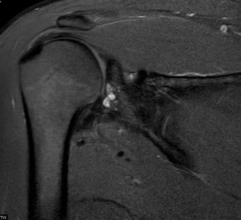 Glenoid Subchondral Cystic Lesion -Approach. - Sumer's Radiology Blog