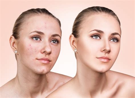 The Skin Before and after Acne Removal by the Experts