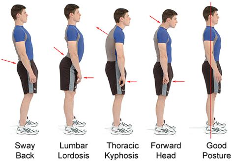 Hyperlordosis and Posture - Target Massage