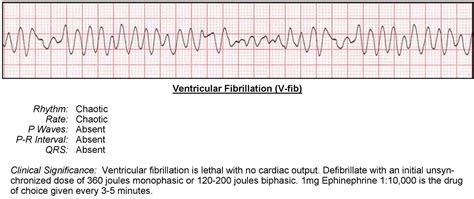 Ventricular Fibrillation - ACLS Wiki