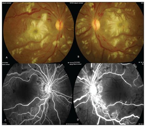 Purtscher-like retinopathy as a first presentation of systematic lupus ...