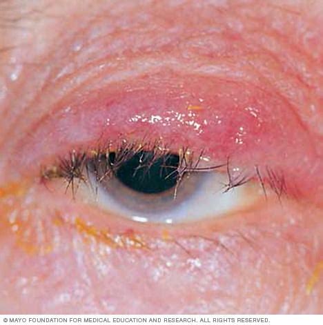 Blepharitis - Symptoms and causes - Mayo Clinic