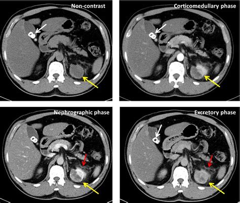 Renal oncocytoma – Radiology Cases