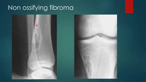 Non ossifying fibroma xray || Fibrous cortical defect xray || Radiology ...