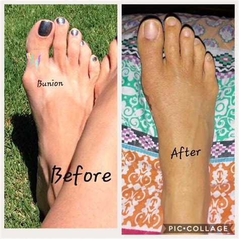 Bunion Surgery - Foot Doctor San Diego / La Jolla Podiatrist