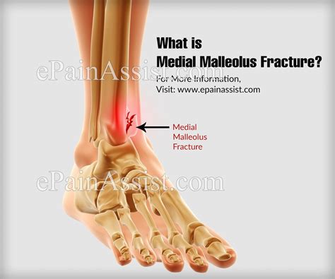 Malleolus Fracture / Operative Treatment Of Posterior Malleolar ...