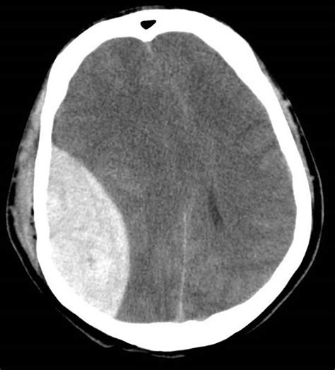 Brain hemorrhage causes, types, symptoms, diagnosis & treatment