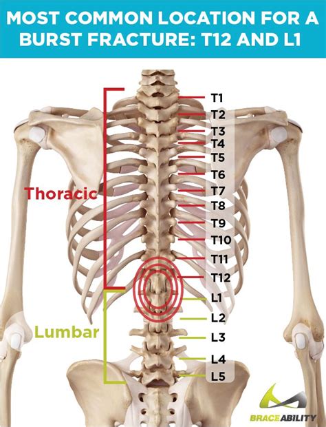 What Does it Mean If I’ve Been Diagnosed with a T12 or L1 Vertebral ...