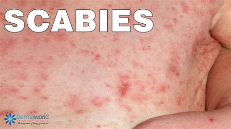 What are Scabies? How are they caused? How to Cure them? - YouTube