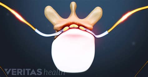 Thoracic Disc Herniation Symptoms