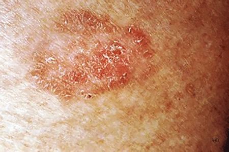 Skin cancer: Squamous cell carcinoma symptoms