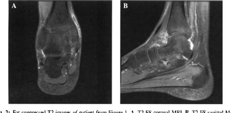 Figure 1 from Painful Bone Marrow Edema Syndrome of the Foot and Ankle ...