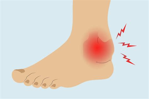 Arthritis in the Ankle: Treatments, Exercises, and Home Remedies