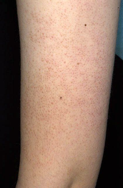 Keratosis Pilaris Pictures (Images, Photos)