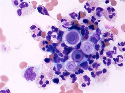 Cryptococcus Neoformans Csf Gram Stain