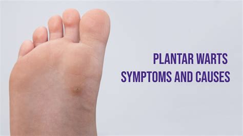 Plantar warts - Symptoms and Causes – Wart Wizard