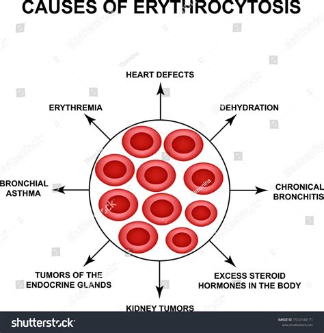 Causes Erythrocytosis Causes Increased Red Blood 스톡 벡터(로열티 프리 ...