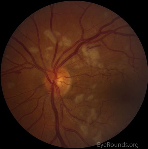 Purtscher Retinopathy