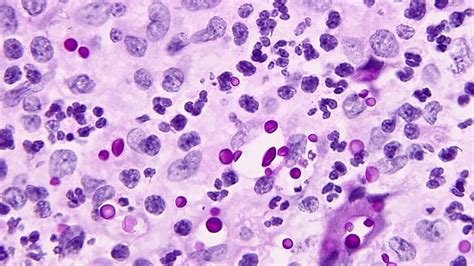 Cryptococcus Neoformans Gram Stain