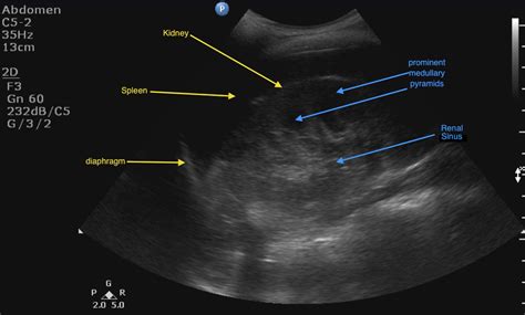 Kidney Ultrasound Labeled