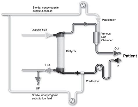 Hemodiafiltration | Abdominal Key