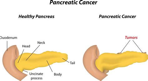 Laparoscopic Treatment : Purpose, Procedure & Recovery: Pancreatic ...