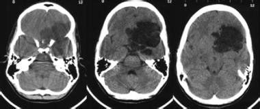 Brain Epidermoid Cyst (Epidermoid Tumor) Imaging: Practice Essentials ...