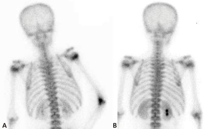 A 3-phase bone scan shows diffuse, elevated tracer uptake in the right ...