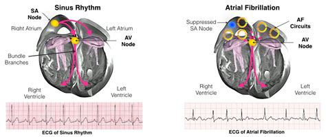 Atrial Fibrillation Ablation - Melbourne Heart Rhythm