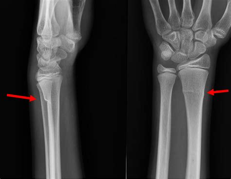 Buckle fracture