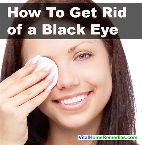 How to Get Rid of a Black Eye | Vital Home Remedies | Black eye ...