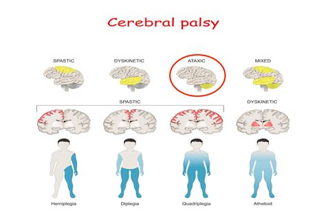 Ataxic Cerebral Palsy | LegalFinders