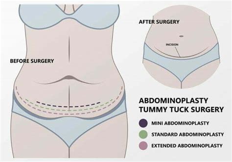 Tummy Tuck Miami - $4000 Best Price | Boutinic Aesthetics