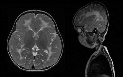 Radshare: METACHROMATIC LEUKODYSTROPHY