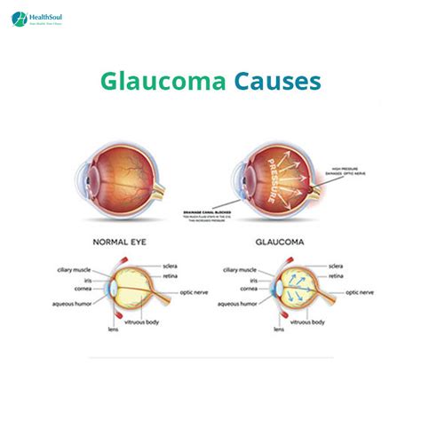 Glaucoma: Symptoms, Diagnosis and Treatment – Healthsoul