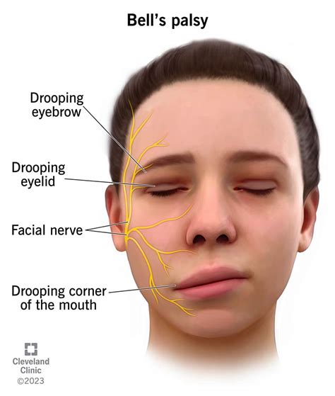 Bell’s Palsy: What It Is, Causes, Symptoms & Treatment