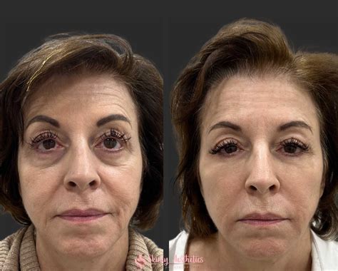 Under Eye Fillers - Before & After Results at Skinly