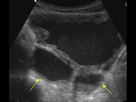 Urinary Tract and male reproductive system | 2.2 Bladder : Case 2.2.3 ...