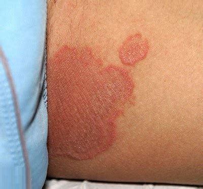 Symptoms causes treatment of disease: Inner Thigh Rash