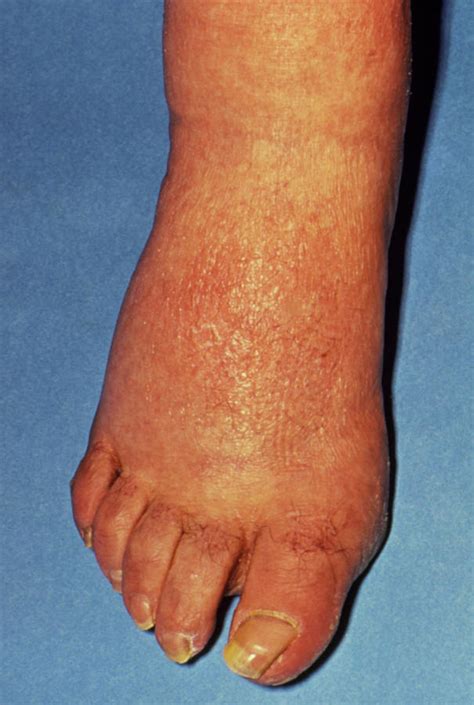 Rash & Swelling On Foot Due To Secondary Syphilis Photograph by Science ...