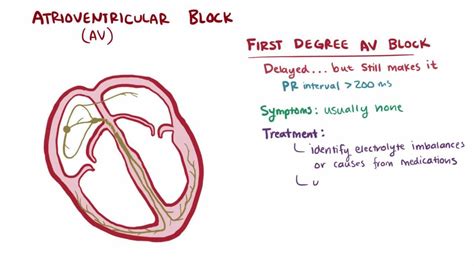 First Degree Av Block