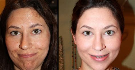 Jessner Peel Photos: A Blogger's Before & After Guide to Chemical Peels