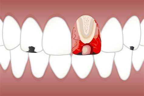 Broken Tooth Extraction: Understanding the Pros and Cons | by Peter ...