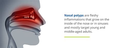 Nasal Polyp Causes Symptoms Treatment Nasal Polyp